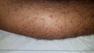 Palpable Purpura HSP  Henoch  Schonlein Purpura [upl. by Eanahs533]