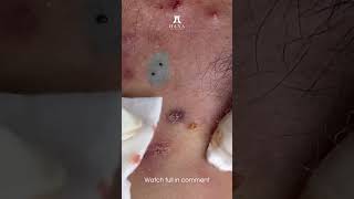 Effective Treatments for Whiteheads and Blackheads [upl. by Ybocaj]