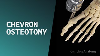 Chevron Osteotomy [upl. by Ecirtal889]