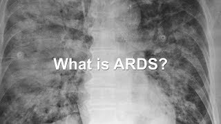 Developing New Treatments for ARDS A Devastating Condition [upl. by Aisenat]