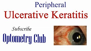 Peripheral Ulcerative Keratitis Introduction Systemic Symptoms Clinical Features and Treatment [upl. by Ellezig]