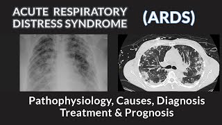 Acute Respiratory Distress Syndrome ARDS  Pathophysiology Causes Diagnosis and Management [upl. by Brana]