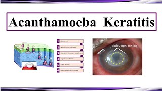 Acanthamoeba Keratitis [upl. by Aillij]