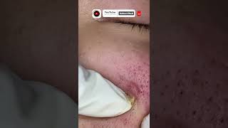 Cystic acne and blackheads removal  Newest pimple pops for 2022 [upl. by Knapp]