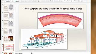 Bacterial Keratitis Part 1 [upl. by Harad104]