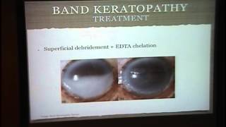 Band Keratopathy Interstitial Keratitis [upl. by Ines482]