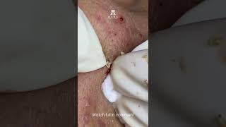 Big Cystic Acne Blackheads Extraction Blackheads amp Milia Whiteheads Removal Pimple Popping shorts [upl. by Slin]