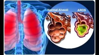 Acute Respiratory Distress Syndrome ARDS [upl. by Kneeland]