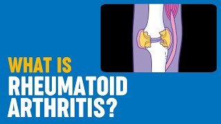 Rheumatoid Arthritis RA vs Osteoarthritis OA  Rheumatology Series [upl. by Emerald536]