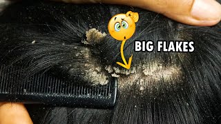 Dandruff Scratching Big Flakes Dandruff Removal Satisfying 289 [upl. by Ylrebma294]