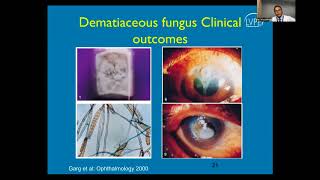 Lecture Fungal Keratitis [upl. by Otanod421]