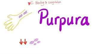 Pupura  Bleeding Disorders [upl. by Goodhen330]