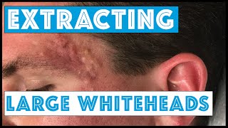 Acne Vulgaris and Extracting large Whiteheads  Part 1 [upl. by Patin985]