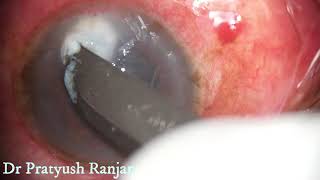 Therapeutic Corneal Ulcer Scraping [upl. by Hepzi]