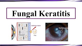 Fungal Keratitis [upl. by Isadora]