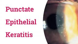 Punctate Epithelial Keratitis PEK [upl. by Maryjo]