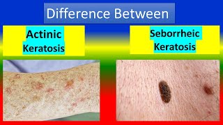 Difference between Actinic keratosis and Seborrheic keratosis [upl. by Emie196]