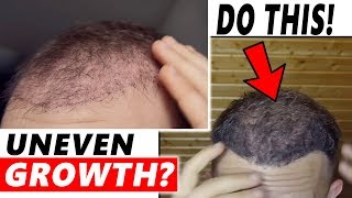 Uneven Growth after Hair Transplant DO THIS [upl. by Aihsemek798]