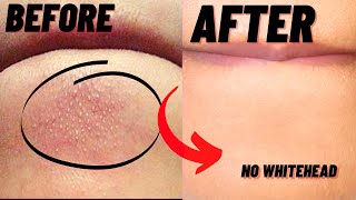 How To Remove Whiteheads And Blackheads From Chin At Home [upl. by Saleme]