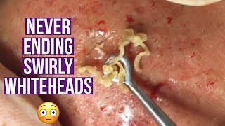 Blackhead and whitehead extractions relaxing amp satisfying [upl. by Trebor]