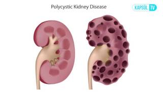 Böbrek Kisti Nedir Neden Olur [upl. by Yras]