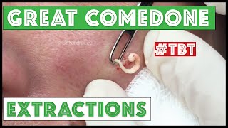 Greatest Blackheads and Whiteheads TBT [upl. by Amekahs]