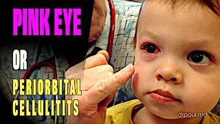 LIVE DIAGNOSIS Pink Eye or Periorbital Cellulitis  Dr Paul [upl. by Tserrof]