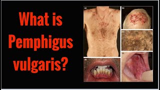 What is PEMPHIGUS VULGARIS Symptoms Causes [upl. by Inoj]