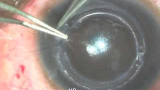 Intacs Insertion for Keratoconus [upl. by Ashlee]