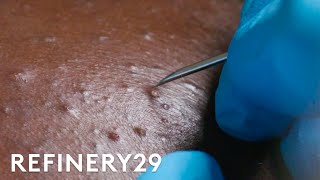 I Got Professional Blackhead Extractions  Macro Beauty  Refinery29 [upl. by Clerk]