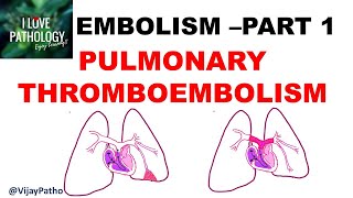 EMBOLISM Part 1 Pulmonary amp Systemic thromboembolism [upl. by Hildagarde]