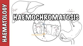 Haemochromatosis Iron Overload  iron physiology causes and pathophysiology [upl. by Yreva]