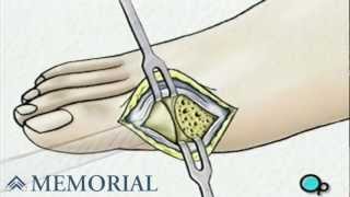 Bunion Removal Foot Surgery [upl. by Romeon]