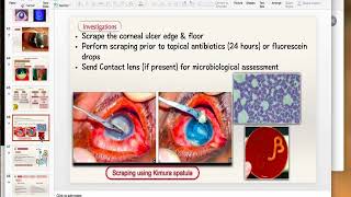 Bacterial Keratitis Part 2 [upl. by Eduardo]