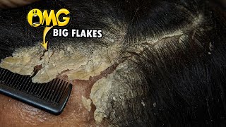 Dandruff Removal Big Flakes Satisfying 811 [upl. by Golden372]