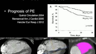 Pulmonary embolism echo in all [upl. by Aryamoy]