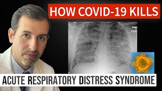 How Coronavirus Kills Acute Respiratory Distress Syndrome ARDS amp COVID 19 Treatment [upl. by Aliak40]