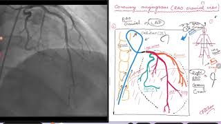 Coronary Angiogram RAO cranial view [upl. by Theis]