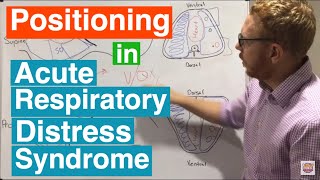 Prone Positioning in Severe ARDS [upl. by Cornell]