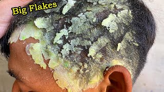 ASMR  Dandruff Scratching ASMR Big Flakes 176 [upl. by Palgrave]