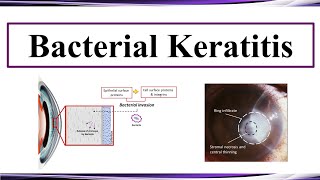 Bacterial Keratitis [upl. by Carlyle]