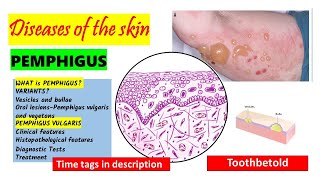 Pemphigus Vulgaris Pathogenesis clinical features oral manifestations  Pemphigus Variants PART 1 [upl. by Kiryt]