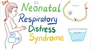 Neonatal Respiratory Distress Syndrome NRDS  Pediatrics  Pulmonology [upl. by Atirahc]