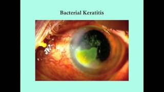 Keratitis  CRASH Medical Review Series [upl. by Aidualc]