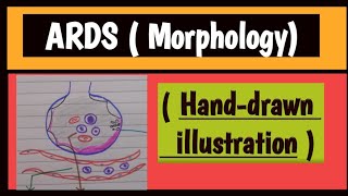 Acute Respiratory Distress Syndrome [upl. by Kcirad]