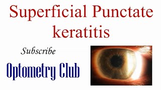 Superficial Punctate Keratitis Introduction Diagnosis and Treatment [upl. by Amoritta]